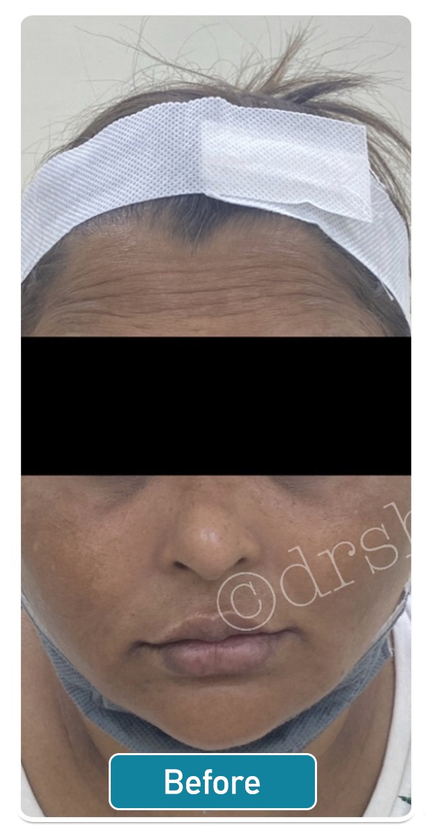 How Much Does Skin Lightening Cost at Virginia Shoemaker blog