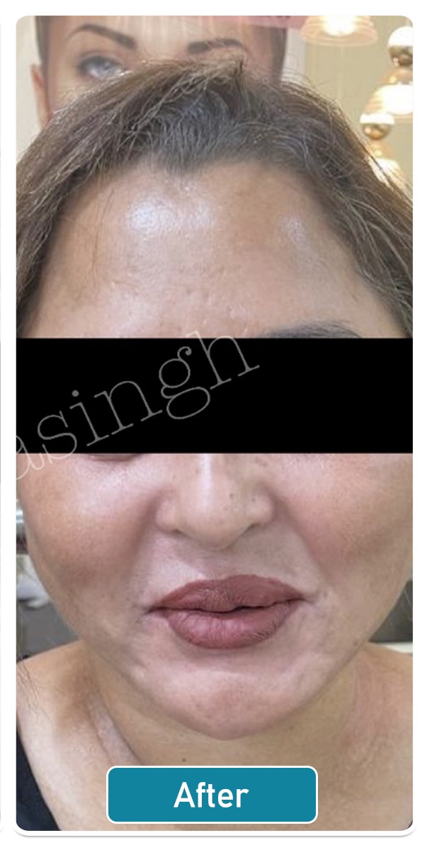 Skin Lightening Treatment Surat Skin Lightening Cost Surat Glamour Skin Studio