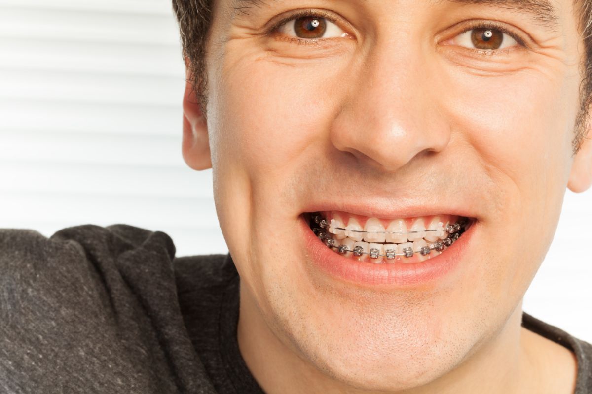 The Different Types of Braces Glass Orthodontics