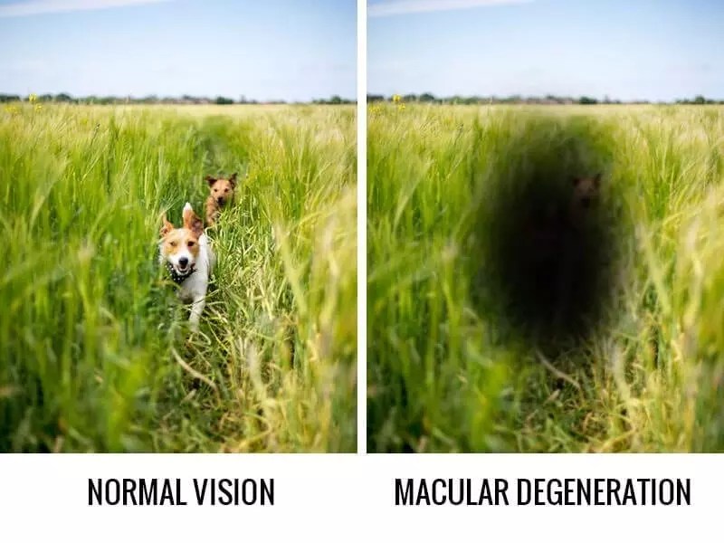 vs Macular Degeneration Philippines