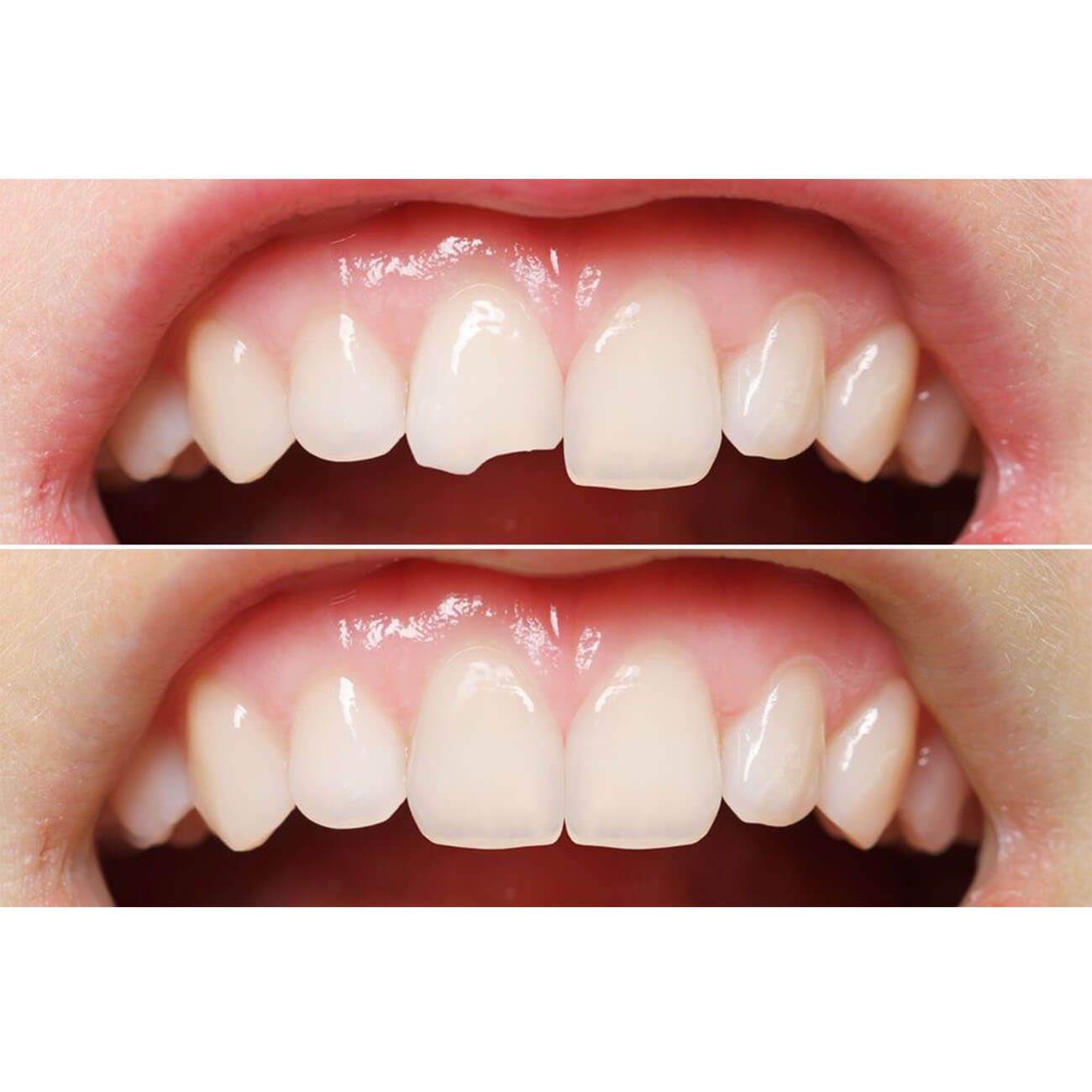 Cracked Teeth Fix Broken Teeth Gleam Dentistry