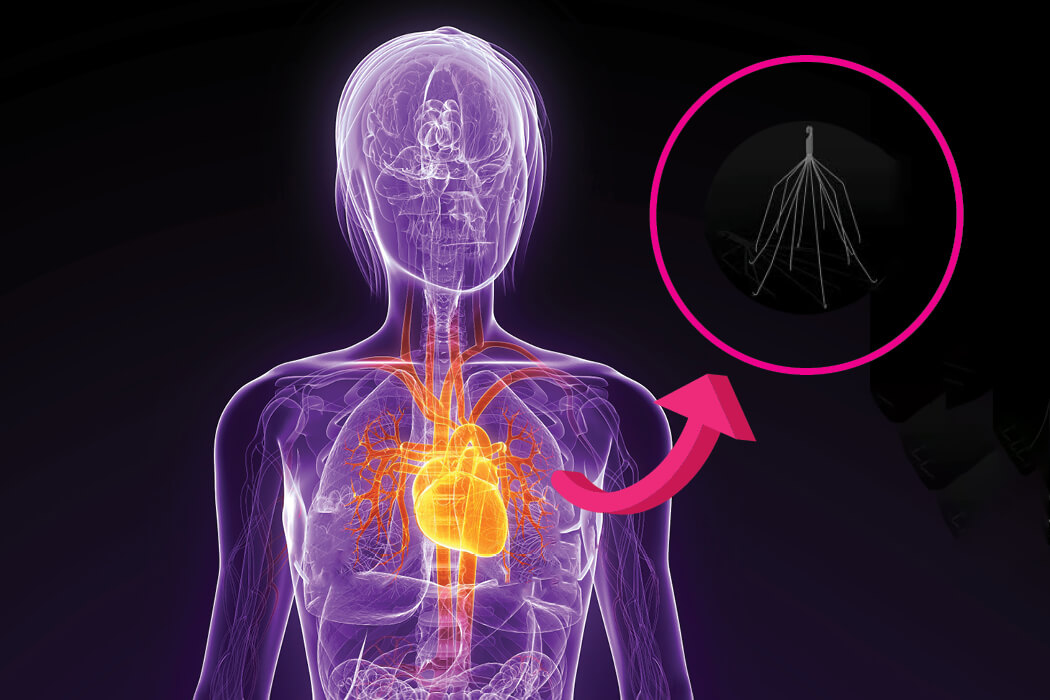 IVC Filter Injury Lawyer Bard G2 Express Filter Claims