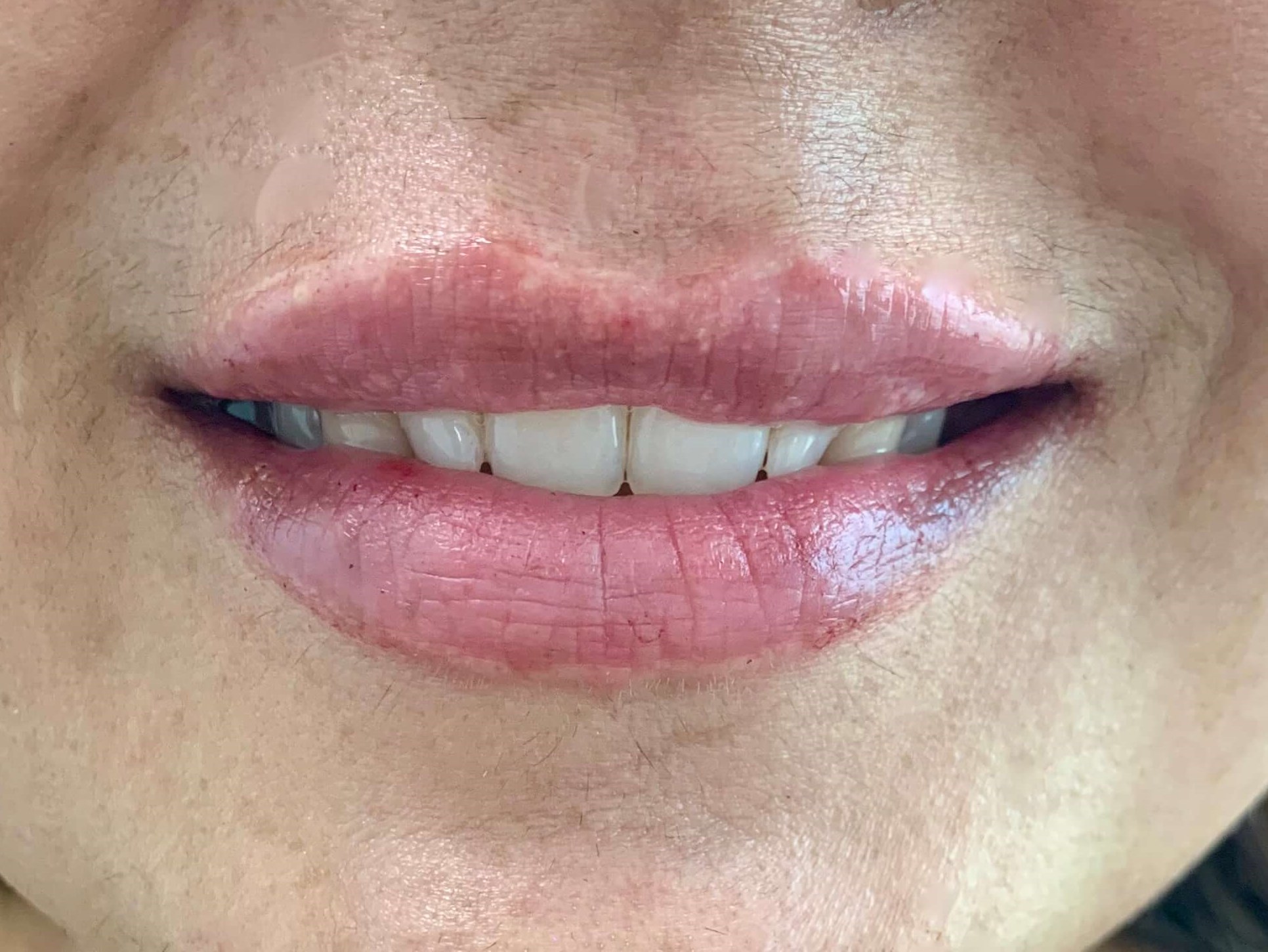 Blood Vessels In Lips Broken