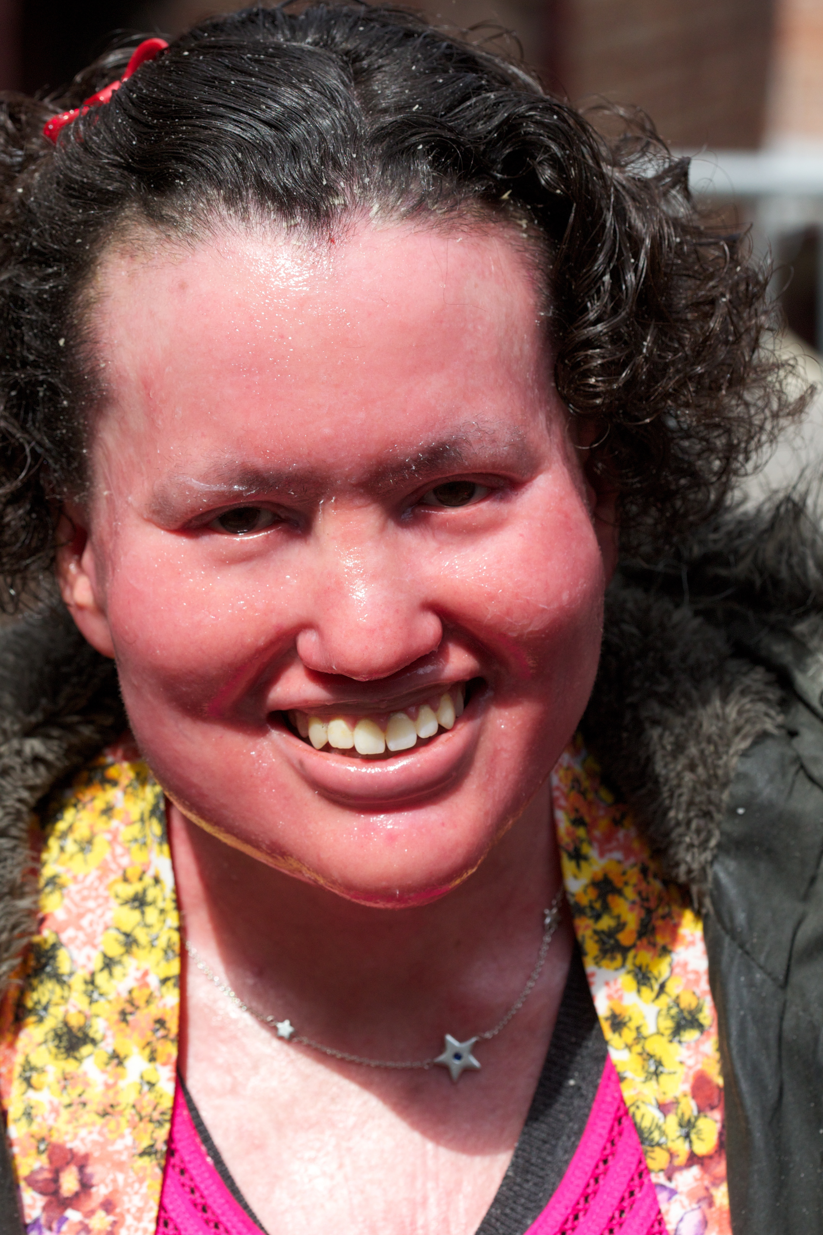 Carly, Who has Ichthyosis, Blogs to Educate Others