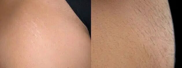 Brazillian Laser Hair Removal | Glow Medispa