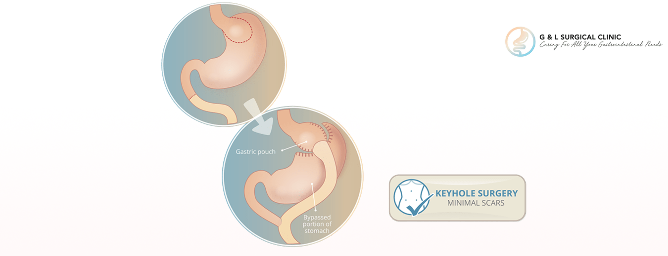 Laparoscopic Gastric Bypass Surgery Singapore | G & L Surgical Clinic
