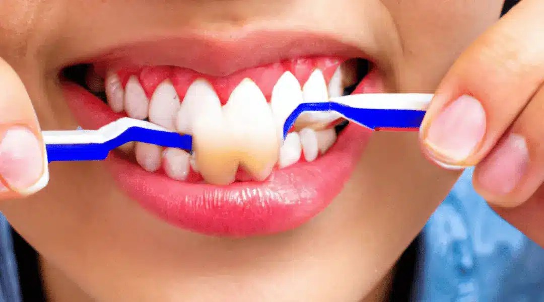 How to Get Super Glue off Teeth Gluedigi