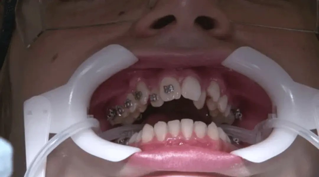 How to Take Braces Glue Off at Home Gluedigi