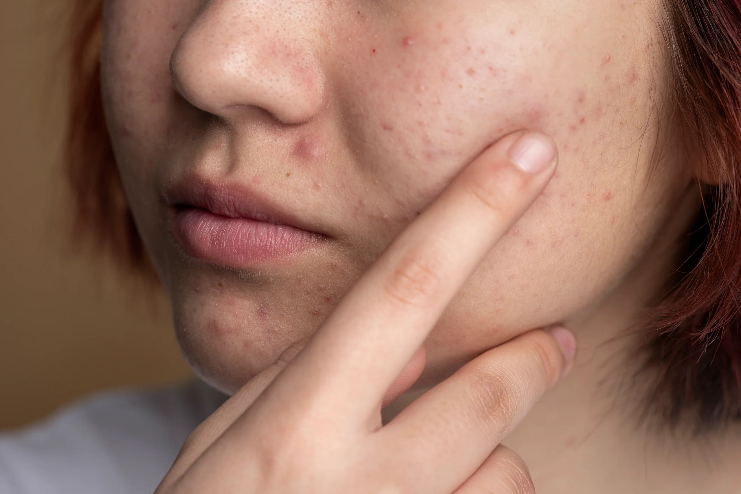 How to Remove Acne Scars GlutaC