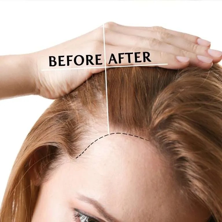 PRP Hair loss therapy The Grand Medical Aesthetic Clinic