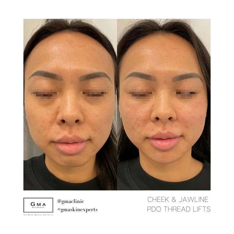 PDO Thread Lift Los Angeles Orange County Skin Perfect, 50 OFF