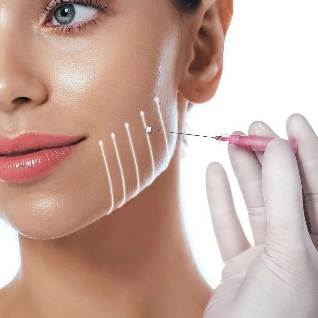 PDO Thread lift Nonsurgical Facelift The Grand Medical Aesthetics