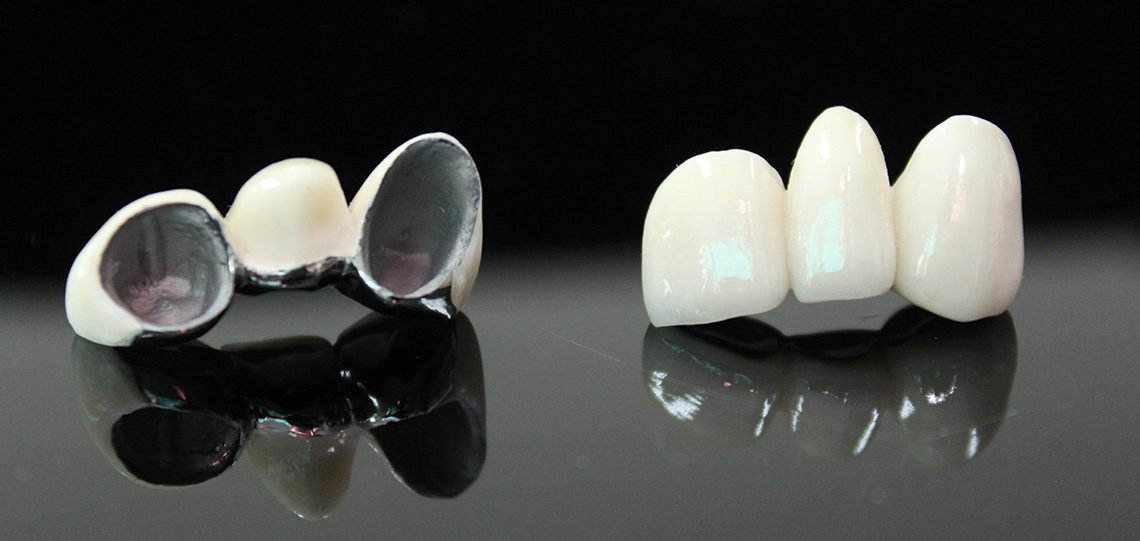 PFM Porcelain Fused to Metal » Gnathodontics