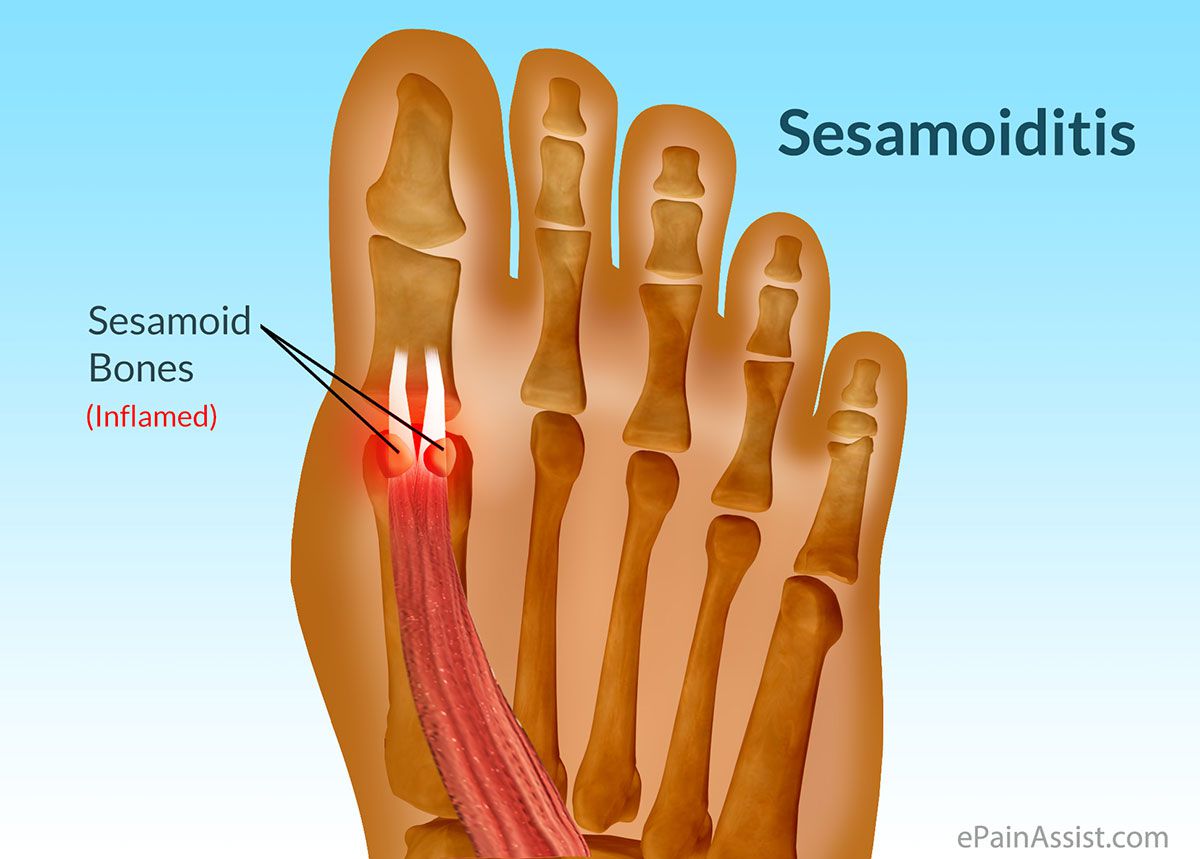 Sesamoiditis (Pain in the big toe!) Treatment for Runners & Walkers