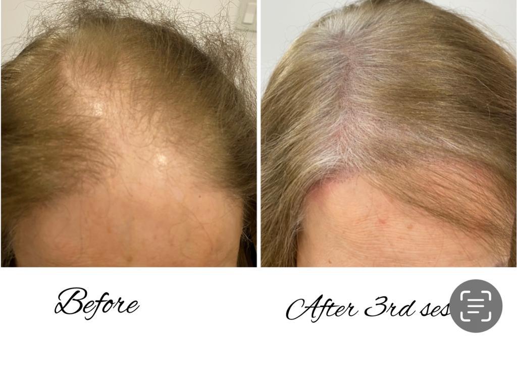 Scalp Micropigmentation for Fair and Blonde Hair Golden Pulse Academy