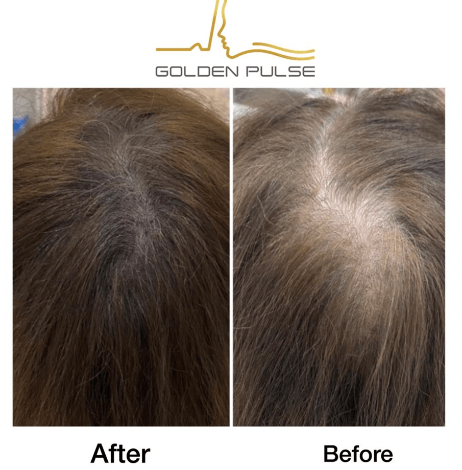 Does Scalp Micropigmentation damage hair follicles? Golden Pulse Academy