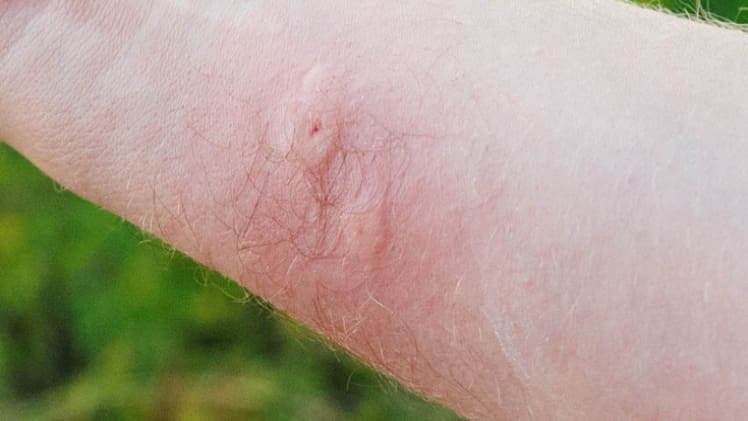 Insect and spider bites and stings — serious Golpanews