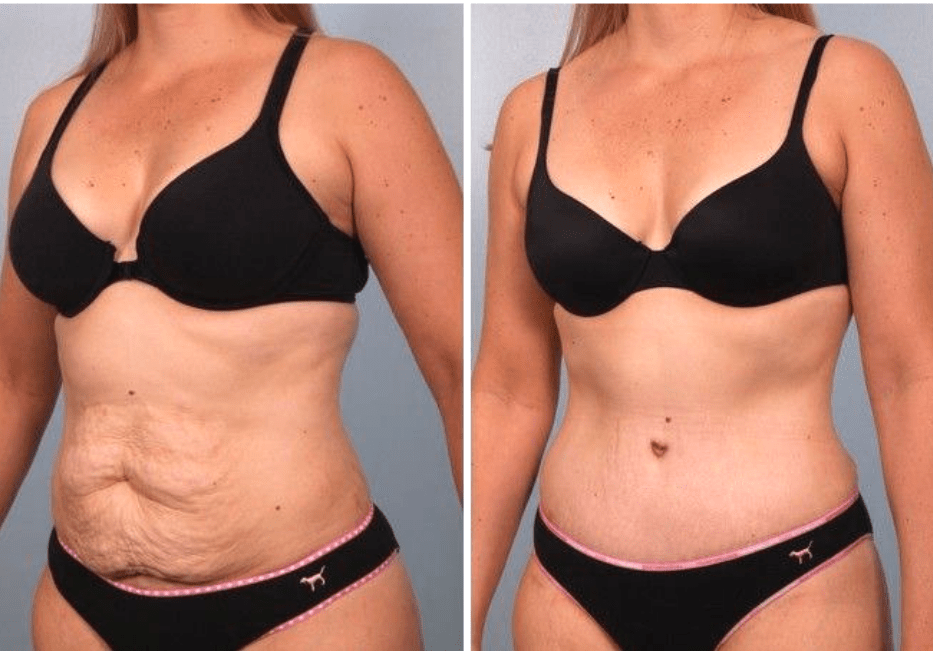 Body Contouring After Losing Weight GOMED