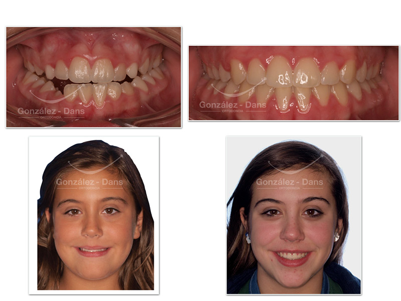 Tengo los dientes montados, ¿qué hago? Solución sin brackets