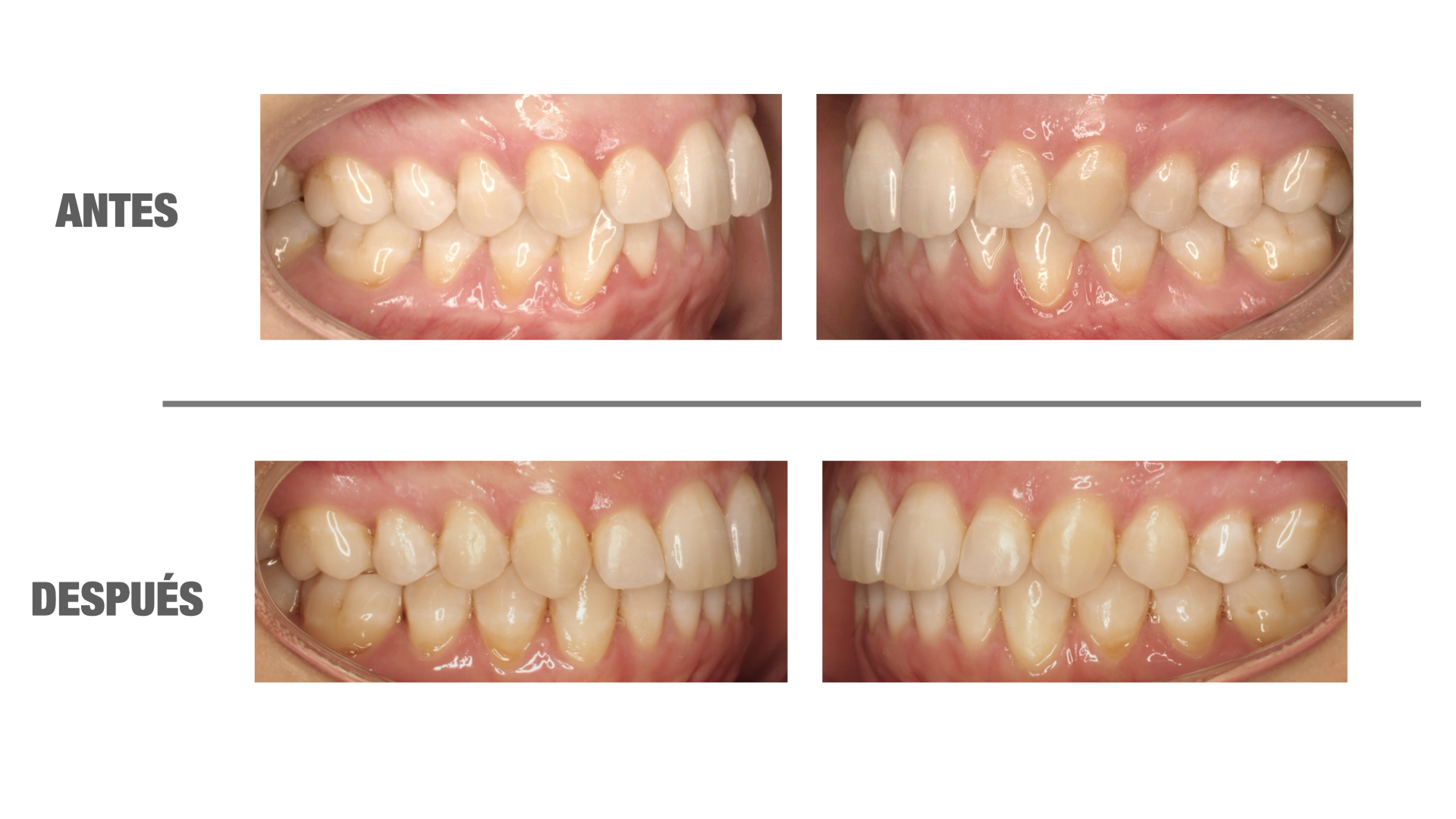 Me quitaron los brackets y se me movieron los dientes, ¿por qué