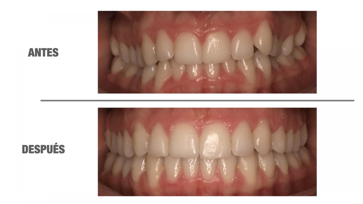 Me quitaron los brackets y se me movieron los dientes, ¿por qué