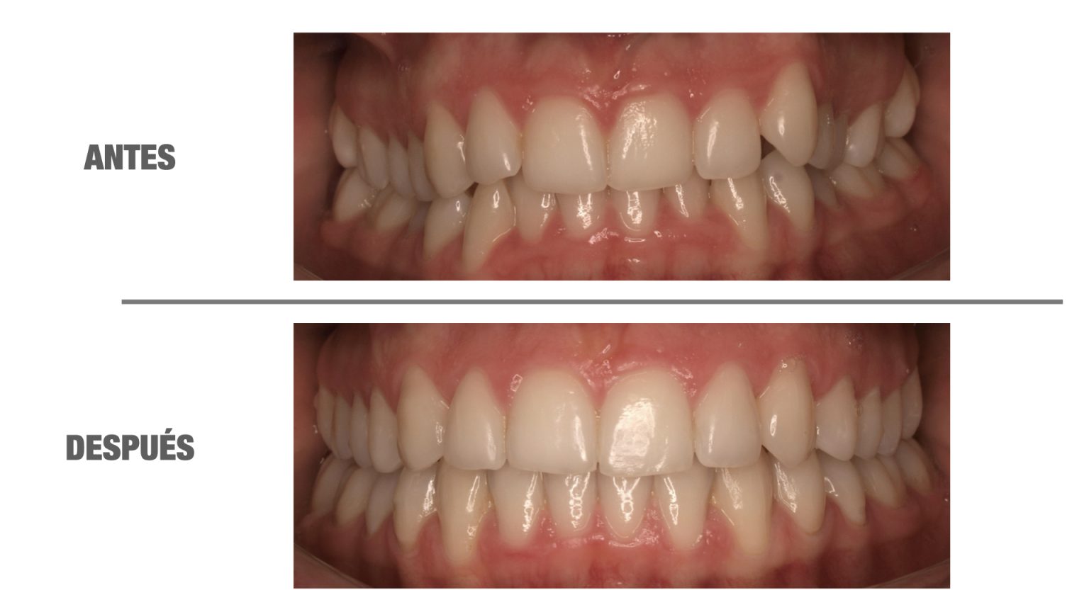 Me quitaron los brackets y se me movieron los dientes, ¿por qué