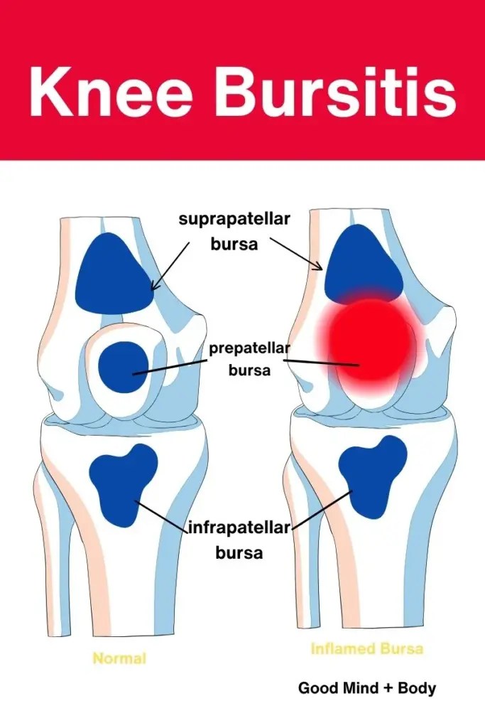 10 Reasons for Sharp Pain in the Knee When Kneeling Good Mind and Body