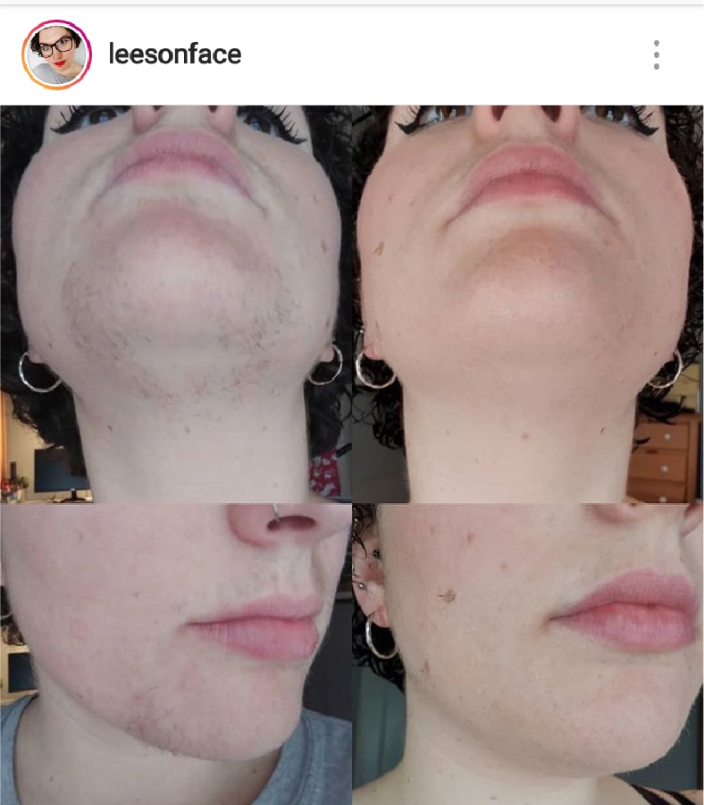 VIDEO Laser Hair Removal Liz's Testimonial Good Skin Days