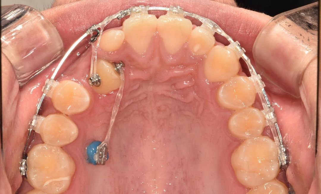 treatment of palatally impacted canine blackshaq... 굿스마일포럼