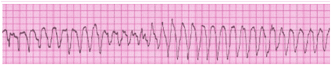 ACLS ECG Rhythm Strips Pretest Question Answers (Quiz) PDF