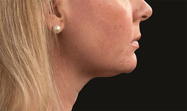 After coolsculpting neck