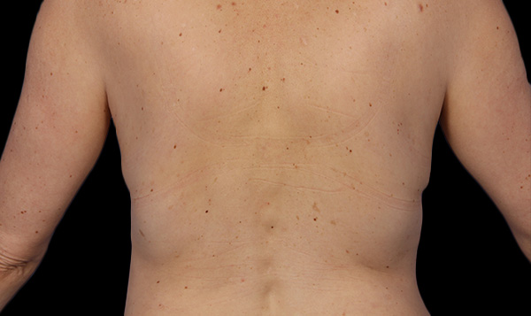After coolsculpting flanks