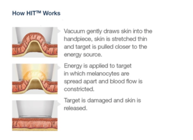 Laser Hair Removal Virginia Laser Hair Removal Northern Virginia VA