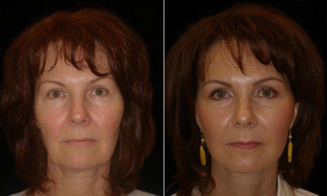 Mini Facelift by Northern Virginia Plastic Surgeon Aesthetica