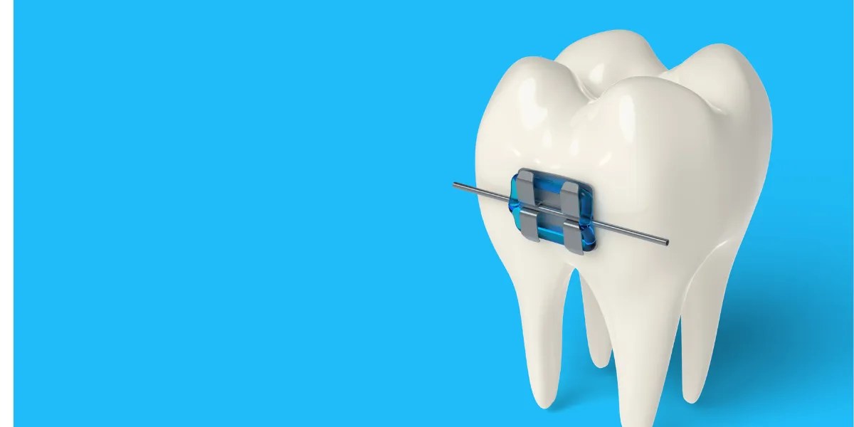 Do Braces Weaken Teeth? Separating Fact from Fiction