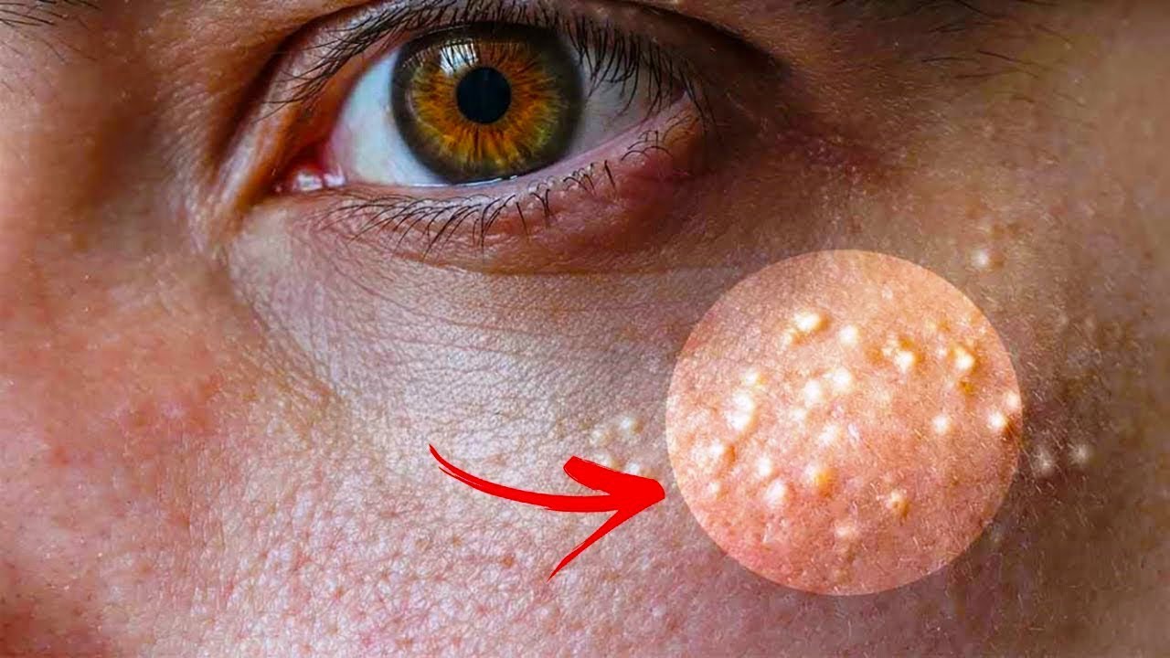 7 Remedies To Get Rid Of Cholesterol Milk Spots Naturally Gotta check