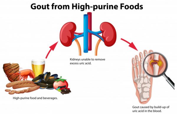 A low purine diet can bring a lot of health benefits. Discover the answers you need here! 7 Days Indian Diet Plan for High Uric Acid and Gout (What to Eat and