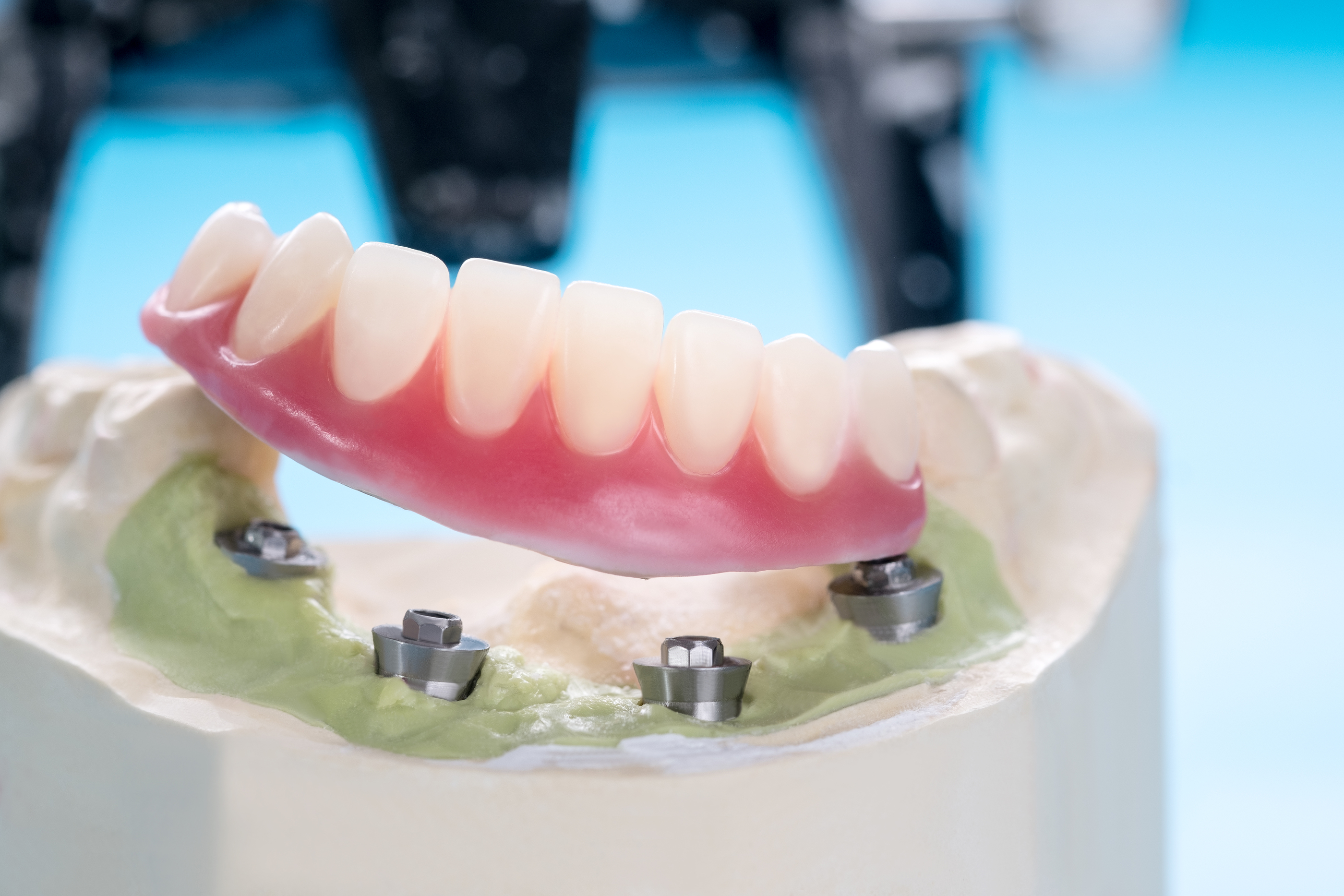 Anchored Dentures in San Jose & Sunnyvale, CA UniSmile Dental