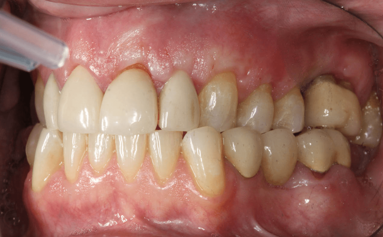 Regenerate Gum and Bone Spring Dental Group