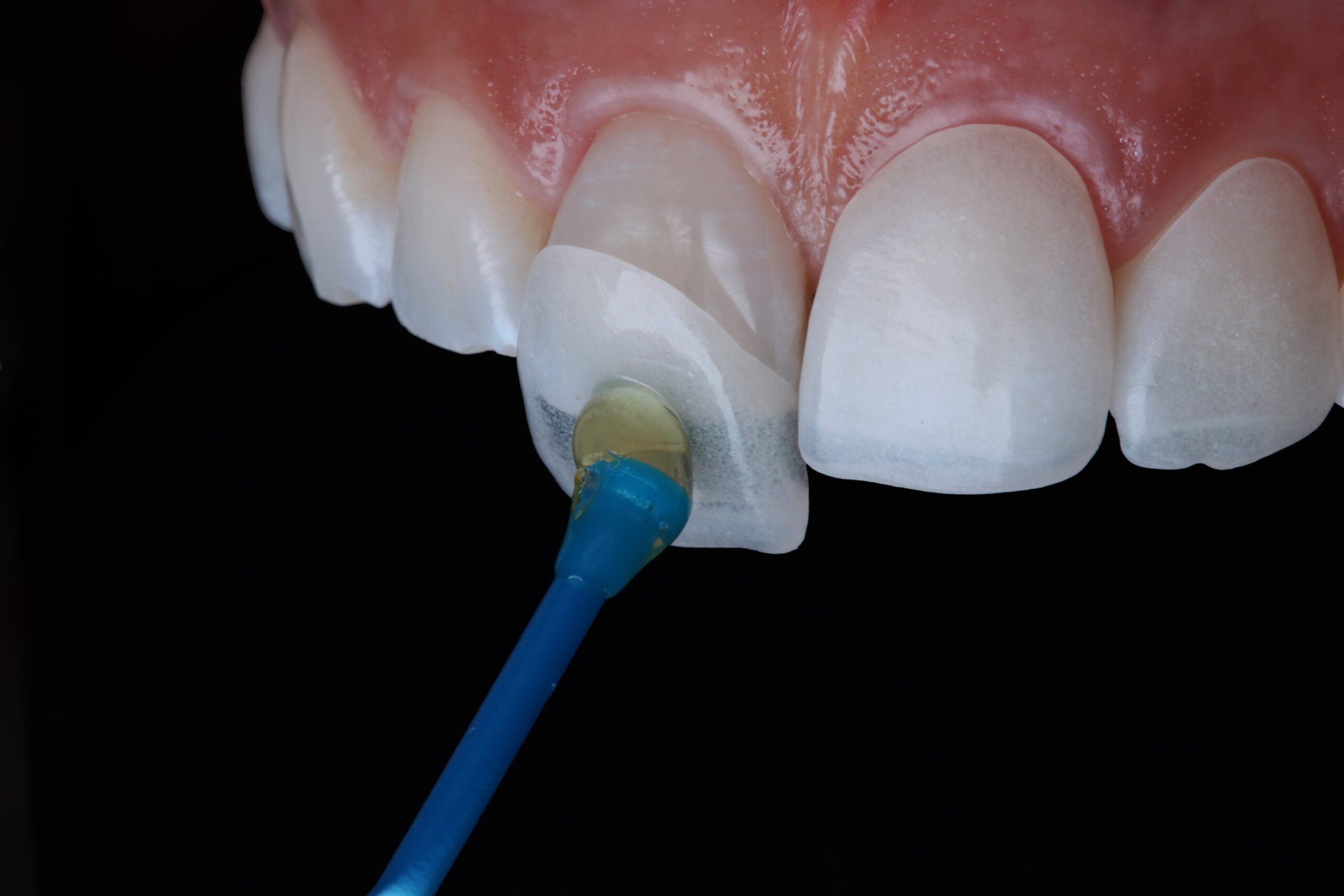 Price For Dental Veneers at Forrest Garza blog