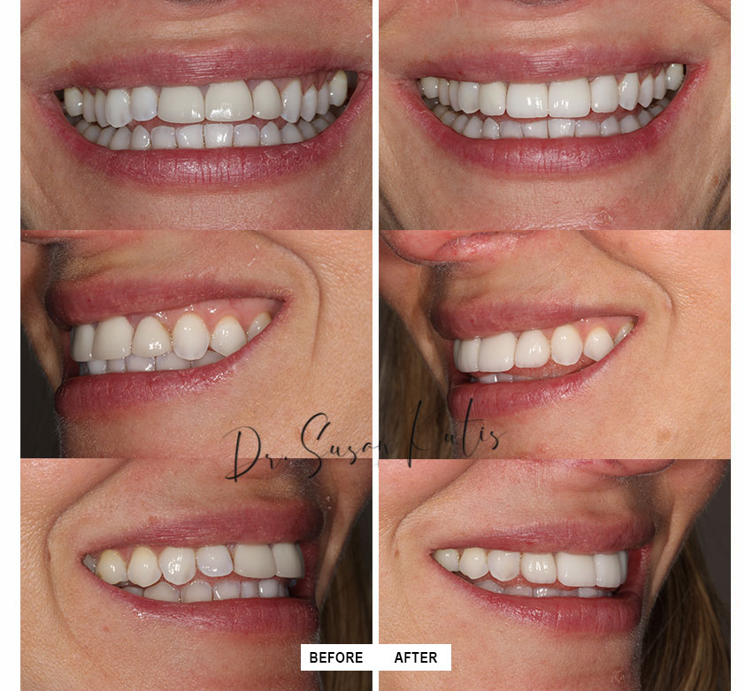 Wrong Tooth Shape or Size Blue Sage Dental Littleton, CO