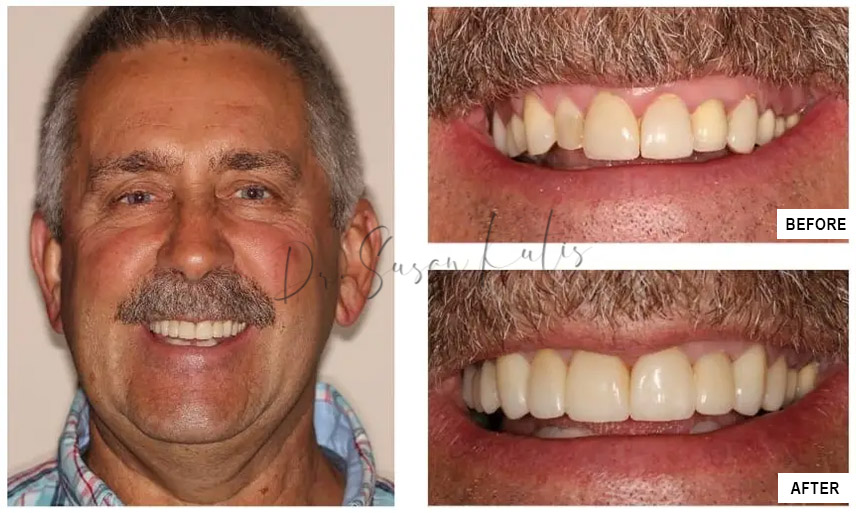 Uneven Teeth Blue Sage Dental Littleton, CO