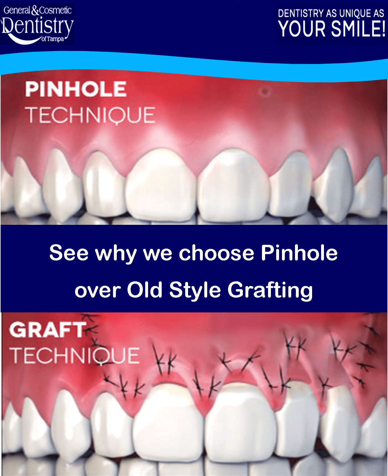 Chao Pinhole Gum Rejuvenation in Tampa, FL General and Cosmetic