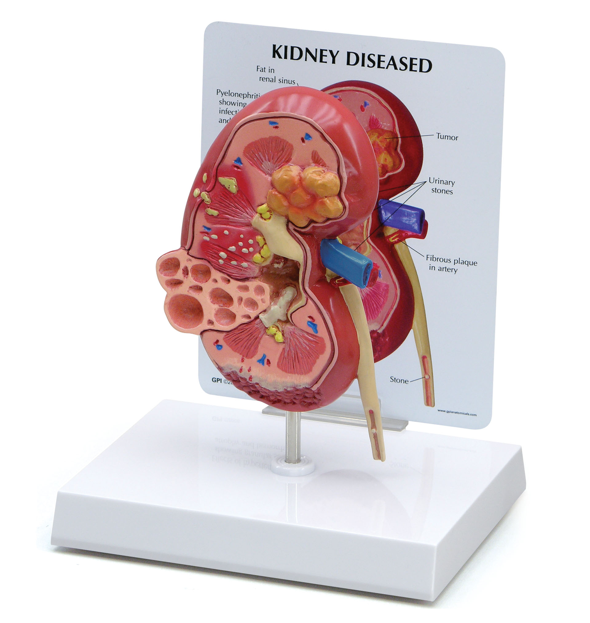Kidney Normal/Pathology Model 3260 GPI Anatomicals