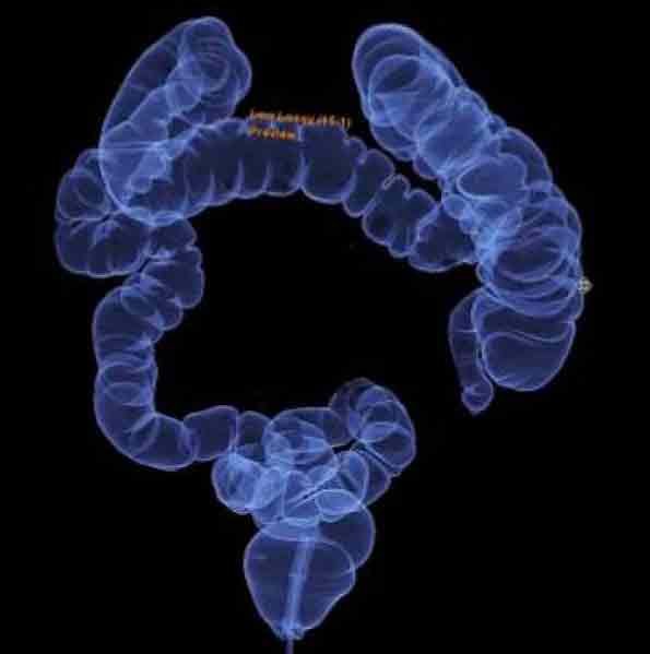 CT Colonography vs Colonoscopy GP Voice