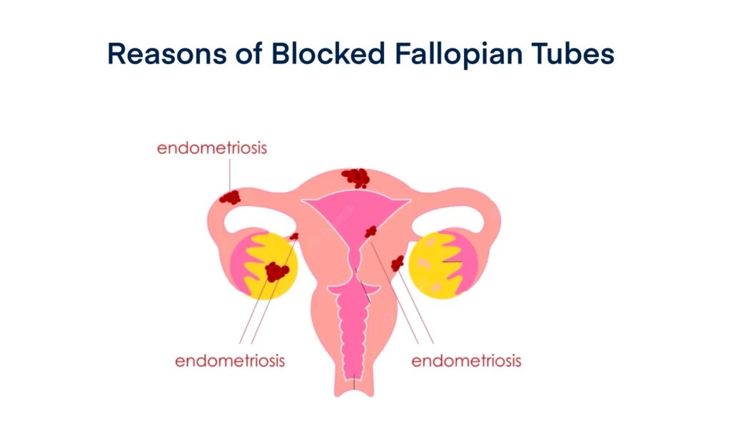 Fallopian Tube Blockage Reason, Test, Treatment Grace Fertility