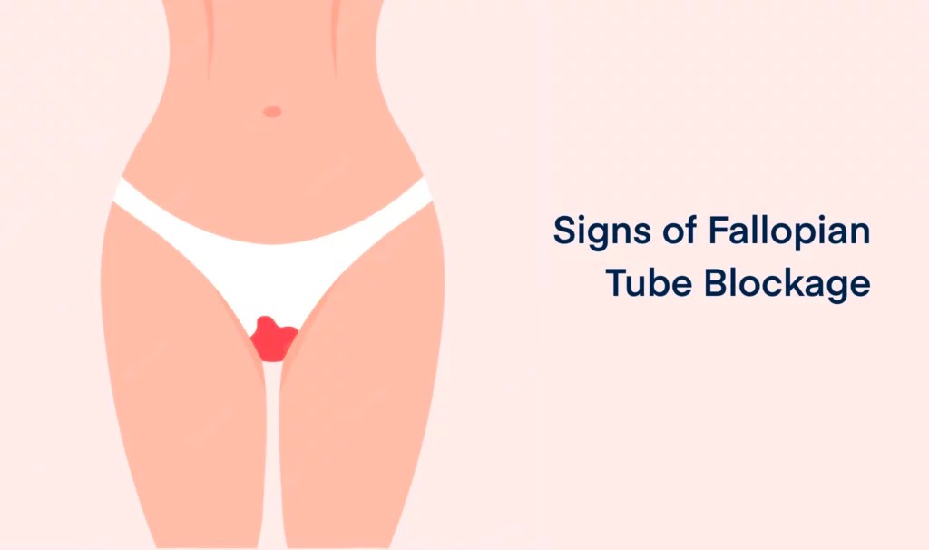 Fallopian Tube Blockage Reason, Test, Treatment Grace Fertility