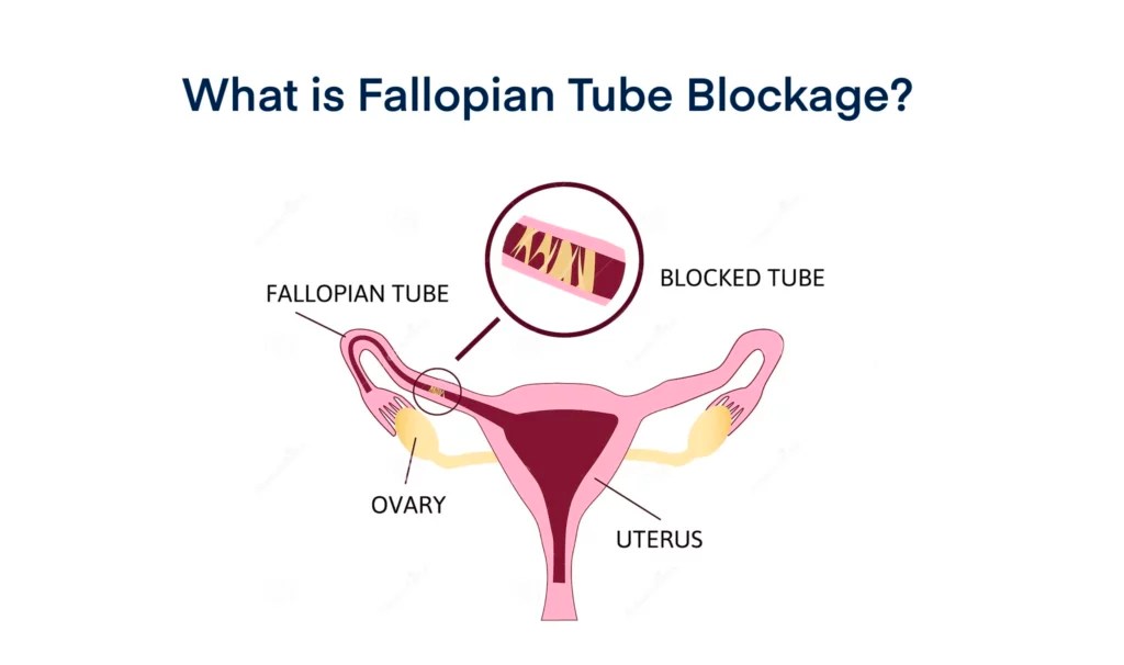 Fallopian Tube Blockage Reason, Test, Treatment Grace Fertility