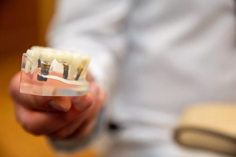 Dental Implant Options Grafy Mag