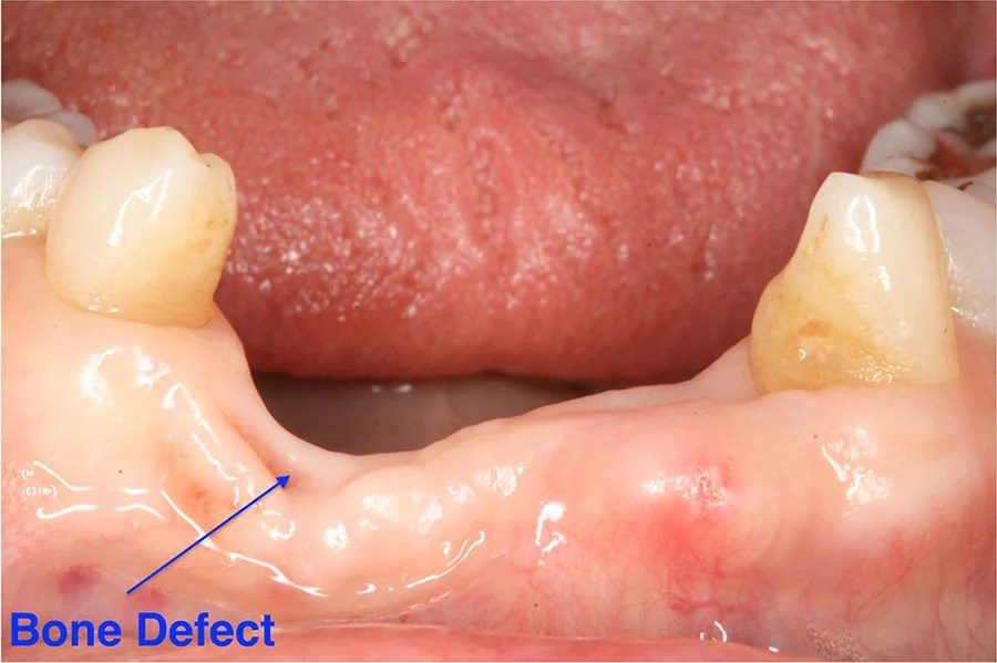 DENTAL SERVICES Bone Graft Grandview Dental Care Thornhill